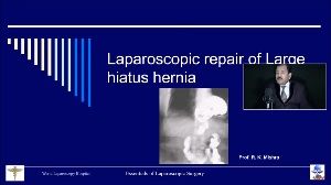 Laparoscopic Mesh Repair of Giant Hiatus hernia