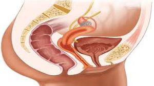 Total Laparoscopic Hysterectomy with Sacrocolpopexy
