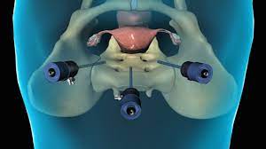 Laparoscopic Hysterectomy with Bilateral Salpingo-oophorectomy and Vault Closure with Weston Knot