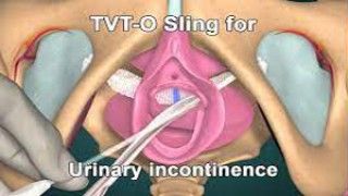 TVT-O Continence Surgery for Stress Urinary Incontinence