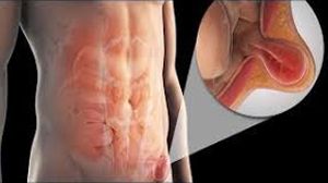 Laparoscopic IPOM Hernia Repair for Inguinal Hernia