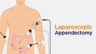 Use of Interceed for adhesion prevention in laparoscopic surgery at World Laparoscopy Hospital