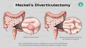 Laparoscopic meckel's diverticulectomy - Management of Symptomatic Meckel's Diverticula