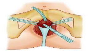 Tension Free Transvaginal Tape Lecture by Dr R K Mishra