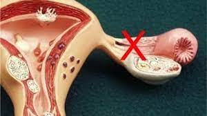 Laparoscopic Assisted Orcheopexy for Undescended testes Demonstration by Dr R K Mishra