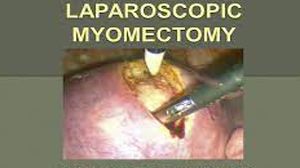 Laparoscopic Myomectomy