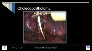 Laparoscopic Choledocotomy