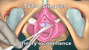 Tension Free Transvaginal Tape TVT and TVTO and TOT