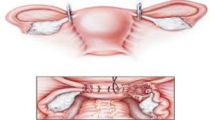 Laparoscopic Radical Hysterectomy
