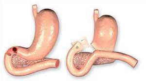 Laparoscopic Repair of Duodenal Perforation