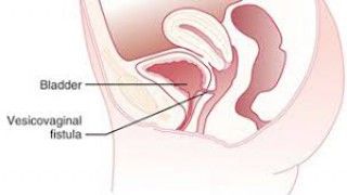 Laparoscopic Surgery For Large Broad Ligament Fibroid