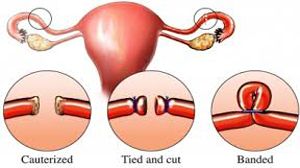 Laparoscopy Tubal Surgery