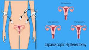Laparoscopy Hysterectomy