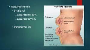 Laparoscopic Management of Ventral Hernia