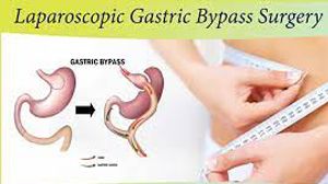 Laparoscopic Management of Endometriosis