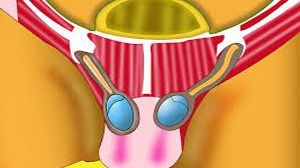 Laparoscopic Repair of Umbilical Hernia