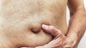 Laparoscopic Repair of Umbilical Hernia HD Video