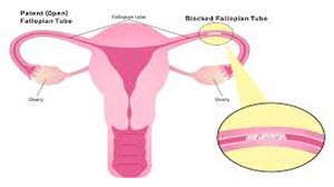 Laparoscopic Tubal Patency test