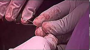 Live Surgery Demonstration of Laparoscopic Mishra's Knot