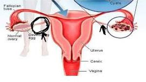 Laparoscopic oophoropexy for recurrent adnexal torsion