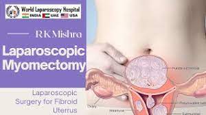 Laparoscopic Myomectomy by Dr R K Mishra