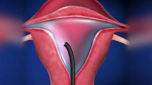 How to do Diagnostic Hysteroscopy?