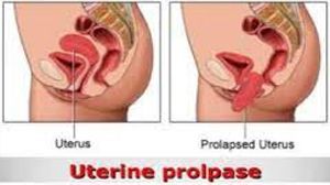 Laparoscopic Surgery for Uterine Prolapse
