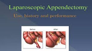 Laparoscopic Appendicectomy by Dr R K Mishra