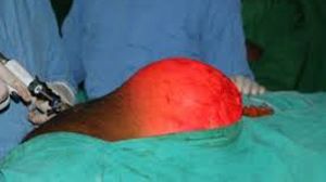 Laparoscopic Repair of Inguinal Hernia Using Intra peritoneal Onlay Mesh & Fibrin Glue