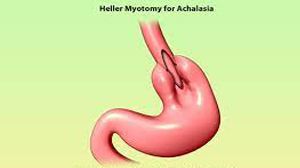 Laparoscopic Heller's Myotomy For Achalasia