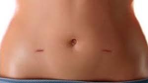 Total Laparoscopic Hysterectomy at World Laparoscopy Hospital