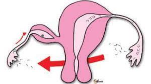 20 सप्ताह की गर्भवती महिला में दर्द पेट के लिए वीडियो ऑफ लेप्रोस्कोपिक एडेसिओलिसिस का वीडियो देखेंl