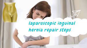 Video Lecture on MGB by Dr. Robert Rutledge, the inventor of MGB at World Laparoscopy Hospital