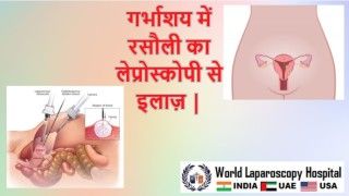 गर्भाशय में रसौली का लेप्रोस्कोपी से इलाज़ |