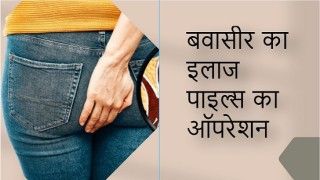 बवासीर का इलाज, पाइल्स का ऑपरेशन | अगर कराने वाले हैं बवासीर की सर्जरी तो ध्यान रखें