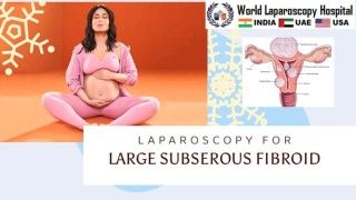 Laparoscopic Removal of Large Subserous Fibroid