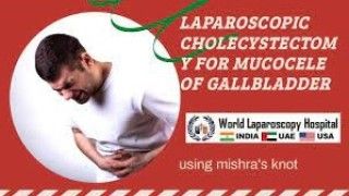 Extracorporeal Knot For Laparoscopic Appendicectomy