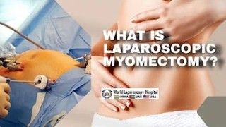 What is Laparoscopic Myomectomy?