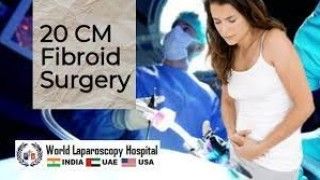 20 CM Large Intramural Fibroid's Laparoscopic Myomectomy