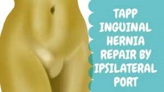 Incisional Hernia IPOM Repair with Dual Mesh