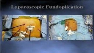 Laparoscopic Fundoplication