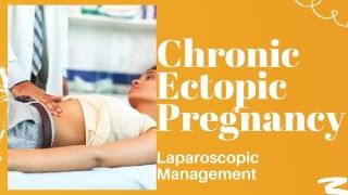 Laparoscopic Surgery for Chronic Ectopic Pregnancy