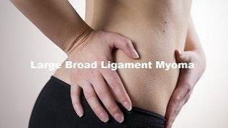 Laparoscopic Myomectomy for Large Broad ligament Fibroid