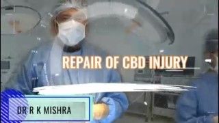 Laparoscopic Repair of Common bile duct (CBD) injury