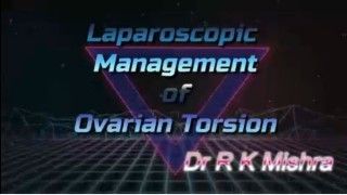 Laparoscopic Surgery for Torsion of Ovarian Cyst