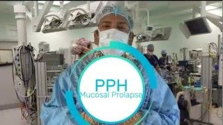 Procedure for prolapse and hemorrhoids (PPH)