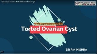 Laparoscopic Resection of a Torted Ovarian Dermoid Cyst