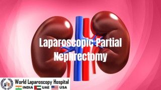 Laparoscopic Partial Nephrectomy