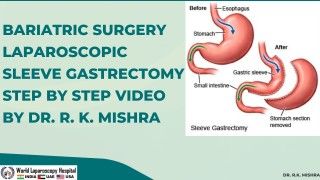 Laparoscopic Sleeve Gastrectomy Skin to Skin Video by Dr. R.K. Mishra