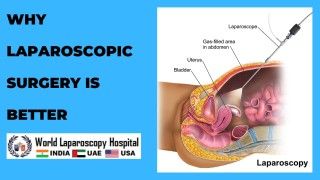 Exploring the Advantages: Discover Why Laparoscopic Surgery is the Preferred Choice for Many